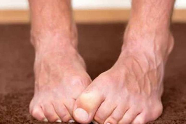 От грибков до диабета: о чем говорят наши ступни?