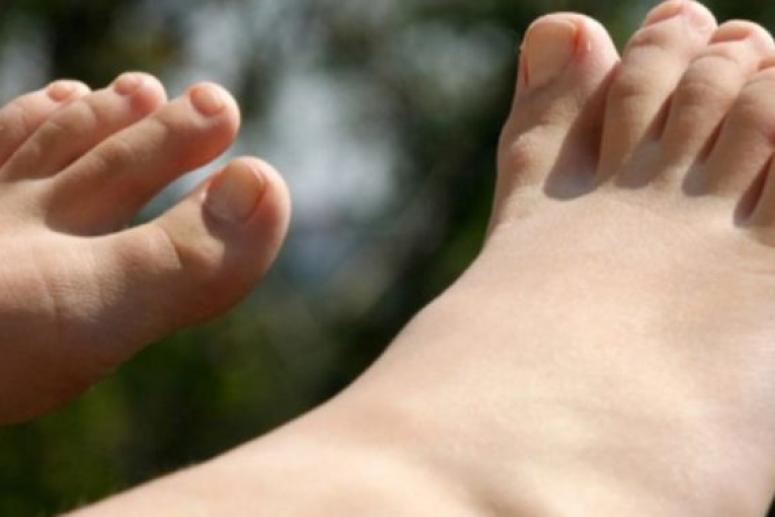 Врачи: отеки в ногах могут указывать на ряд опасных нарушений