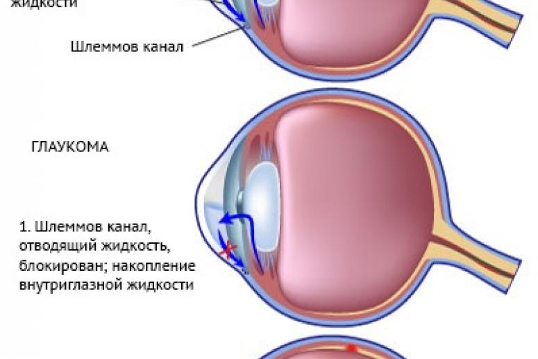 Глаукома — частая причина потери зрения