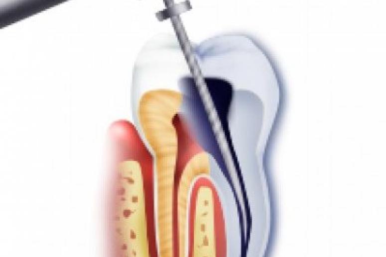 Лечение корневых каналов зубов: методы