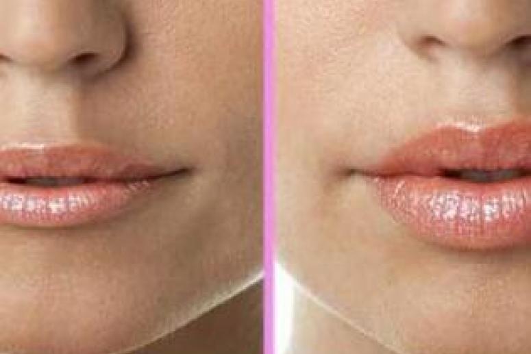 Пластика губ: методы коррекции