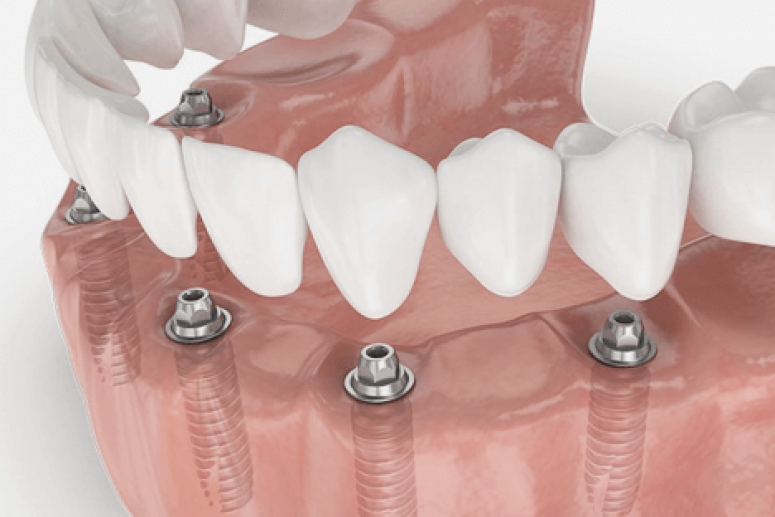 Протезирование зубов: этапы