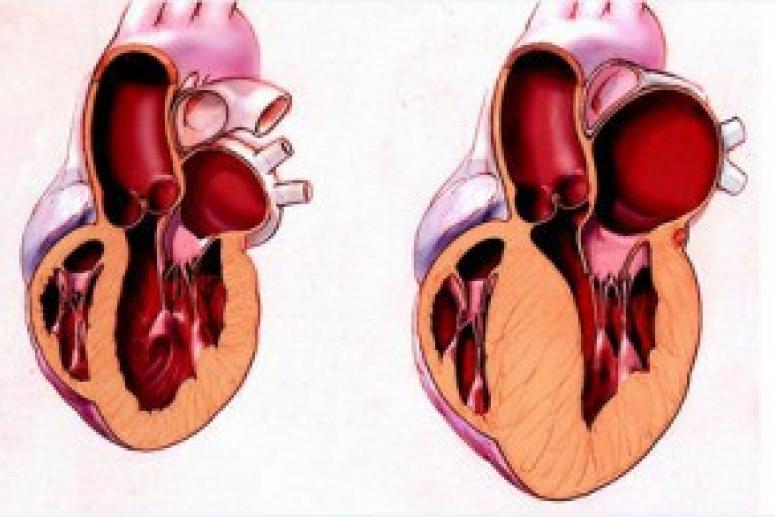 Увеличение размеров сердца
