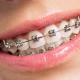 Брекеты для зубов: важная информация для всех